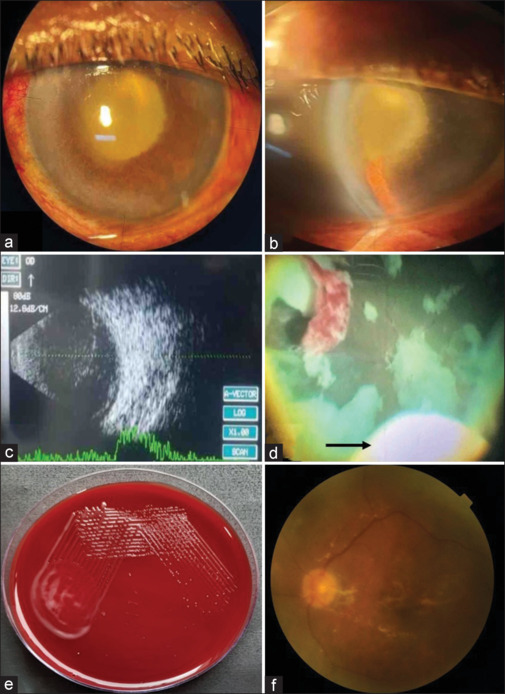 Endophthalmitis caused by <i>Hathewaya histolytica</i>: A diagnostic dilemma.