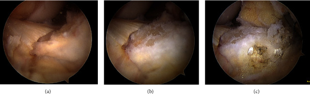Excision of Intra-articular Knee Heterotopic Ossification Using a 70° Arthroscope.