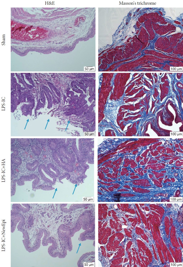 Intravesical Instillation of Hyaluronic Acid With Epidermal Growth Factor for Restoring Urothelial Denudation and Alleviating Oxidative Stress in Lipopolysaccharide-Induced Interstitial Cystitis of Rats.