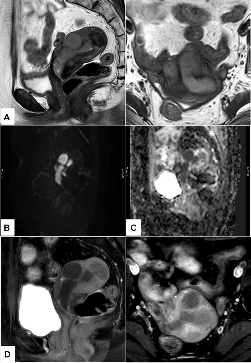 Beyond the Marrow: Unveiling Uncommon Sites of ALL Relapse with <sup>18</sup> F-FDG PET/CT.