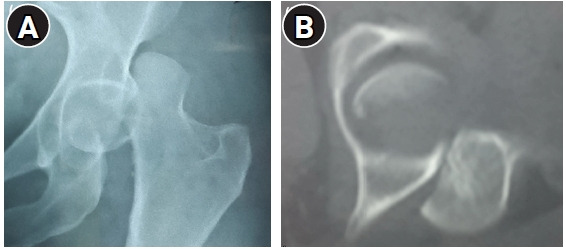 Relevance of the Watson-Jones anterolateral approach in the management of Pipkin type II fracture-dislocation: a case report and literature review.