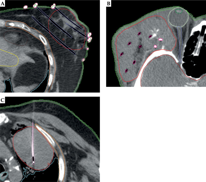 Dosimetric comparison of Acuros<sup>TM</sup> BV and AAPM TG-43 formalism for interstitial iridium-192 high-dose-rate brachytherapy.