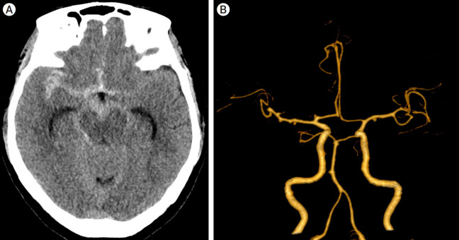 Two consecutive ruptured intracranial aneurysm in patient with multiple intracranial aneurysms.