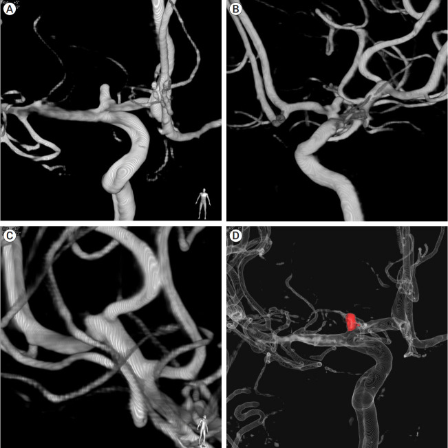 Two consecutive ruptured intracranial aneurysm in patient with multiple intracranial aneurysms.
