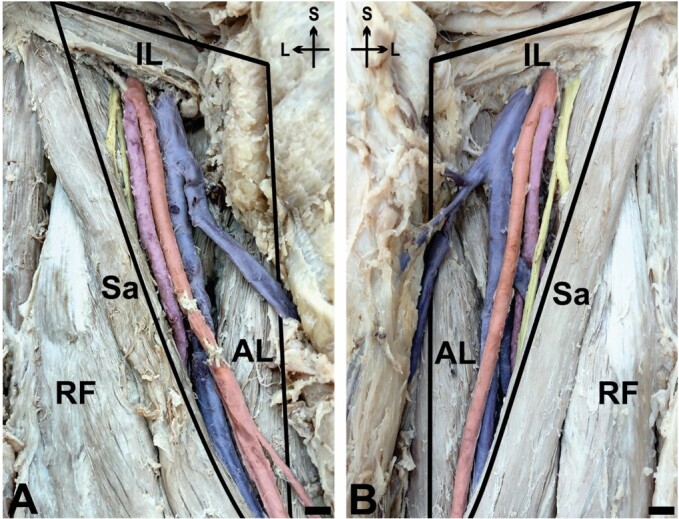 Bilateral high origin and superficial trajectory of the deep femoral artery: clinical and applied anatomy.