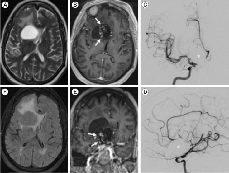Symptomatic perianeursymal cyst development 20 years after endovascular treatment of a ruptured giant aneurysm: Case report and updated review.