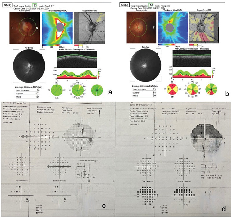 <i>In Vivo</i> Confocal Microscopy and Anterior Segment Optical Coherence Tomography Findings of Patients with Iridocorneal Endothelial Syndrome