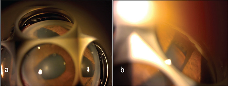 <i>In Vivo</i> Confocal Microscopy and Anterior Segment Optical Coherence Tomography Findings of Patients with Iridocorneal Endothelial Syndrome