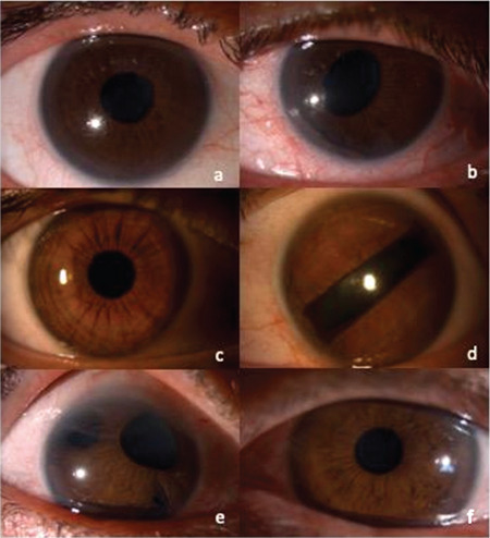 <i>In Vivo</i> Confocal Microscopy and Anterior Segment Optical Coherence Tomography Findings of Patients with Iridocorneal Endothelial Syndrome