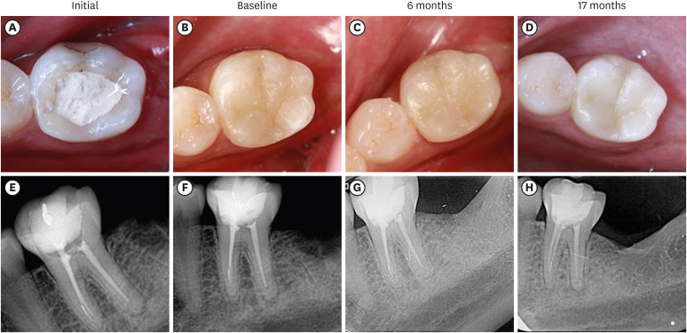 Alkasite restorative material for endodontically treated teeth: a randomized controlled pilot study.