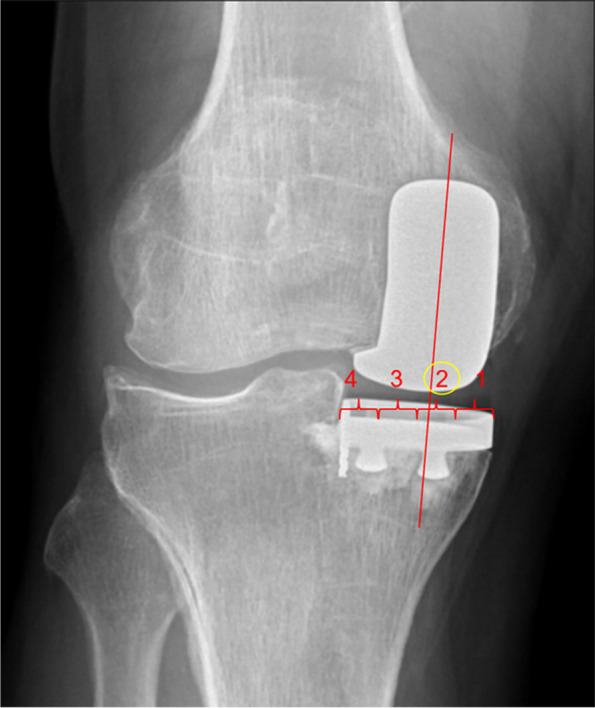 Reducing edge loading and alignment outliers with image-free robotic-assisted unicompartmental knee arthroplasty: a case controlled study.