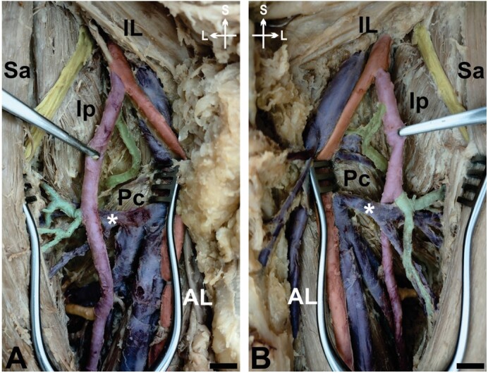 Bilateral high origin and superficial trajectory of the deep femoral artery: clinical and applied anatomy.
