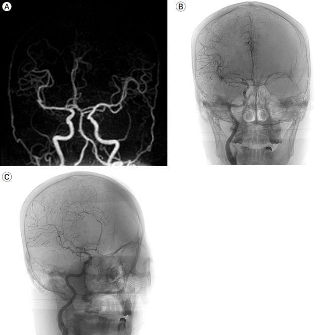 Two consecutive ruptured intracranial aneurysm in patient with multiple intracranial aneurysms.