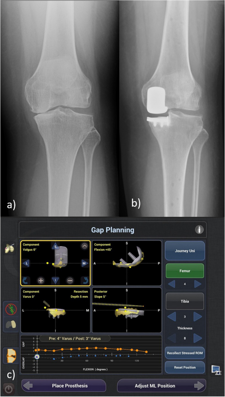 Reducing edge loading and alignment outliers with image-free robotic-assisted unicompartmental knee arthroplasty: a case controlled study.