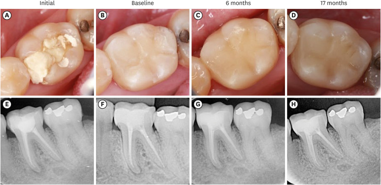 Alkasite restorative material for endodontically treated teeth: a randomized controlled pilot study.