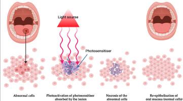 CLINICAL EFFICACY OF PHOTODYNAMIC THERAPY IN MANAGEMENT OF ORAL POTENTIALLY MALIGNANT DISORDERS: A SYSTEMATIC REVIEW AND META-ANALYSIS