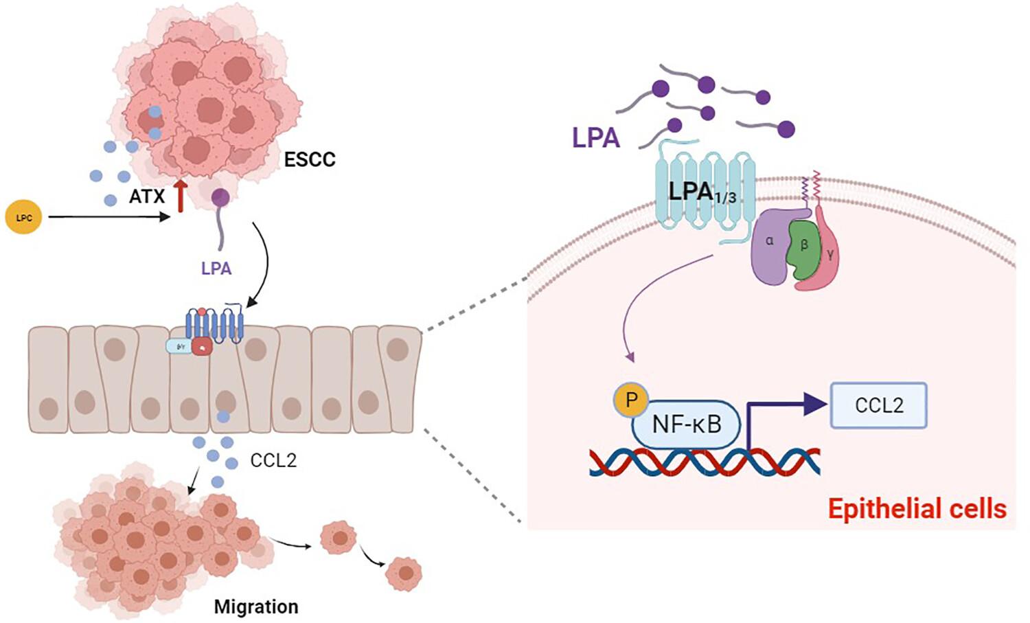 Lysophosphatidic acid promotes ESCC progression by increasing the level of CCL2 secreted by esophageal epithelial cells