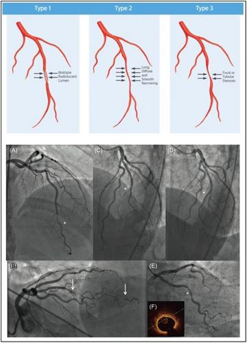 Spontaneous coronary artery dissection (SCAD): A contemporary review