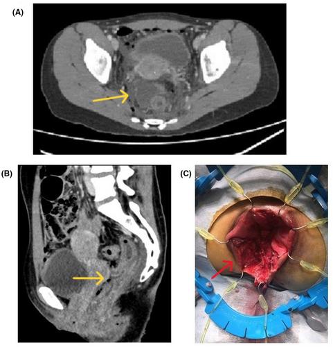 A well-managed case of discontinuous anorectal injury caused by a personal watercraft treated by combining surgery and colonoscopy