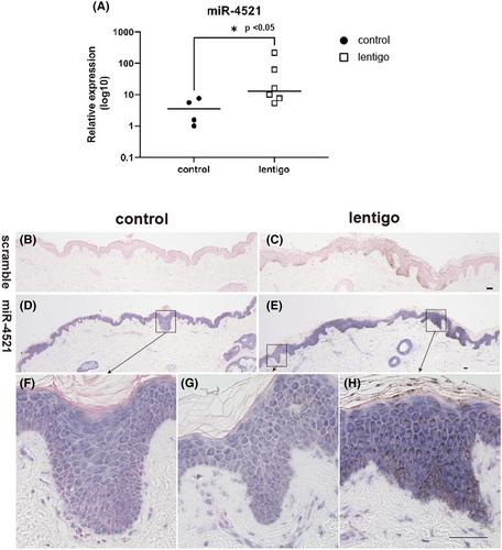 miR-4521—A novel biomarker for human lentigos