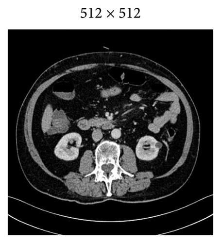 An Intelligent System of Predicting Lymph Node Metastasis in Colorectal Cancer Using 3D CT Scans