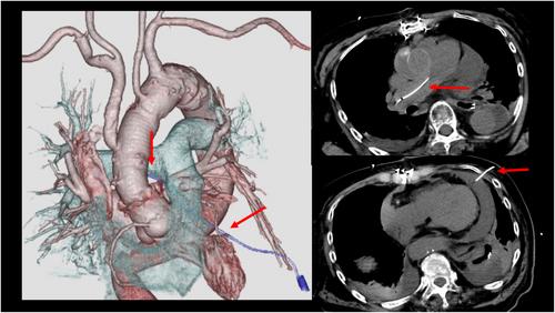 Migration of a pericardial drainage catheter into the right main pulmonary artery