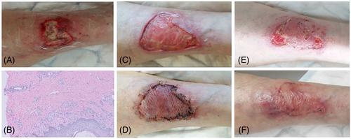 The role of split-thickness skin grafting in the treatment of vasculitic and pyoderma gangrenosum ulcers in a multidisciplinary wound centre