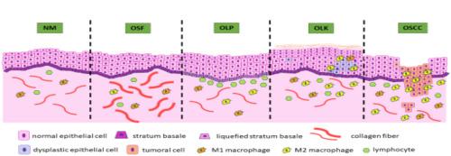 Macrophages infiltration and oral potentially malignant disorders: A systematic review and meta-analysis