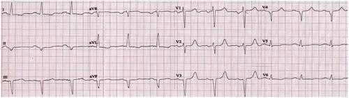 Accelerated idioventricular rhythm as a manifestation of chronic renocardiac syndrome: A case report