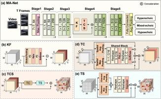 A Multi-Dimensional Aggregation Network Guided by Key Features for Plaque Echo Classification Based on Carotid Ultrasound Video