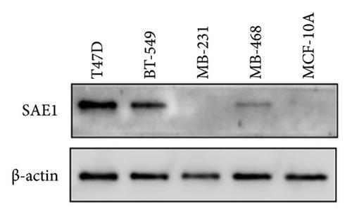 Upregulated SAE1 Drives Tumorigenesis and Is Associated with Poor Clinical Outcomes in Breast Cancer