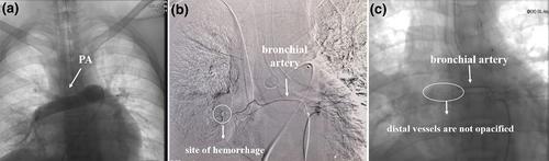 Sudden hemoptysis originating from spontaneous right bronchial artery bleeding during arterial duct closure in an adult patient with chronic myeloid leukemia