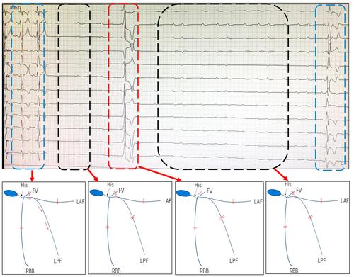 Fasciculoventricular accessory pathway masked extensive atrioventricular conduction system disease in a patient with PRKAG2 syndrome