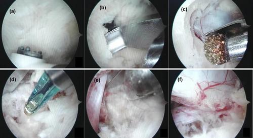 Treatment of lumbar intervertebral disc herniation using open spinal endoscopy: Techniques and clinical outcomes