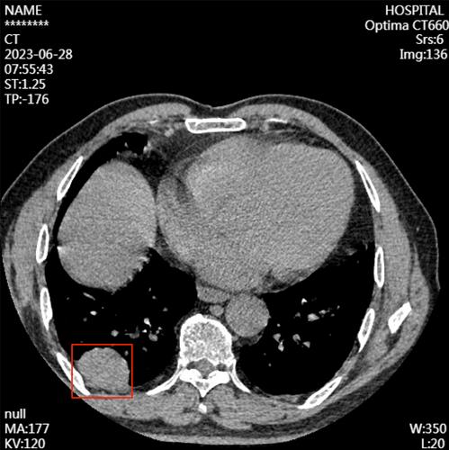 Primary Pulmonary Meningioma With Associated Multiple Micronodules: A Case Report With Comprehensive Diagnostic Overview