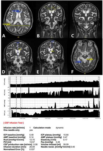 Multimodal diagnostic approaches in a male patient with hydrocephalus indicated by widening of the temporal horns of the lateral ventricles: A case report