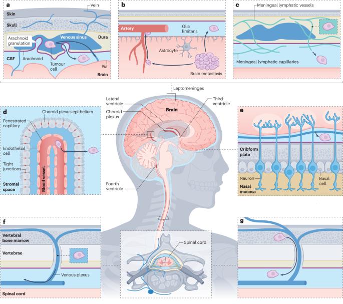 The path to leptomeningeal metastasis