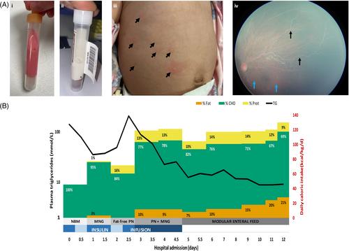 Diagnosis and stabilisation of familial chylomicronemia syndrome in two infants presenting with hypertriglyceridemia-induced acute pancreatitis