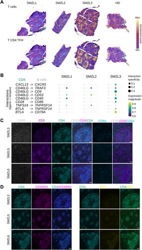 Integrated spatial and multimodal single-cell transcriptomics reveal patient-dependent cell heterogeneity in splenic marginal zone lymphoma