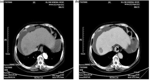 Combined application of the traditional Chinese herbal medicine, Renvatinib, and Carrelizumab in a patient with primary liver cancer: A case report and literature review