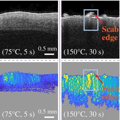 Dynamic optical coherence elastography for skin burn assessment: A preliminary study on mice model