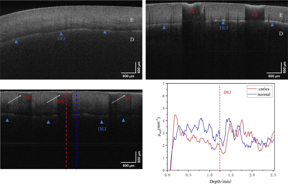 Diagnosis of dental caries based on attenuation coefficients analysis of optical coherence tomography images