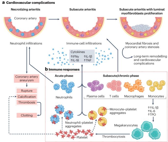 Platelets in Kawasaki disease: mediators of vascular inflammation