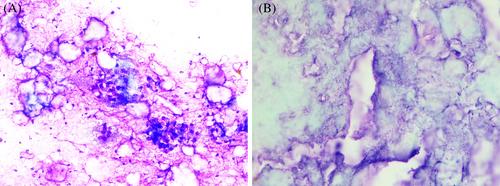 EUS-FNA diagnosis of pancreatic tophaceous gout: Two rare cases