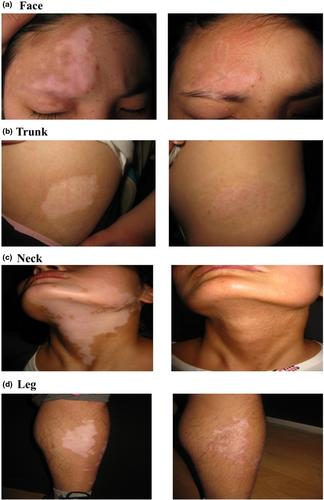 Target area treatment ratio of varied lesions in the cultured pure melanocyte transplantation repigmentation of vitiligo: A retrospective study