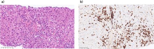 Diagnostic guide for immune checkpoint inhibitor-induced liver injury