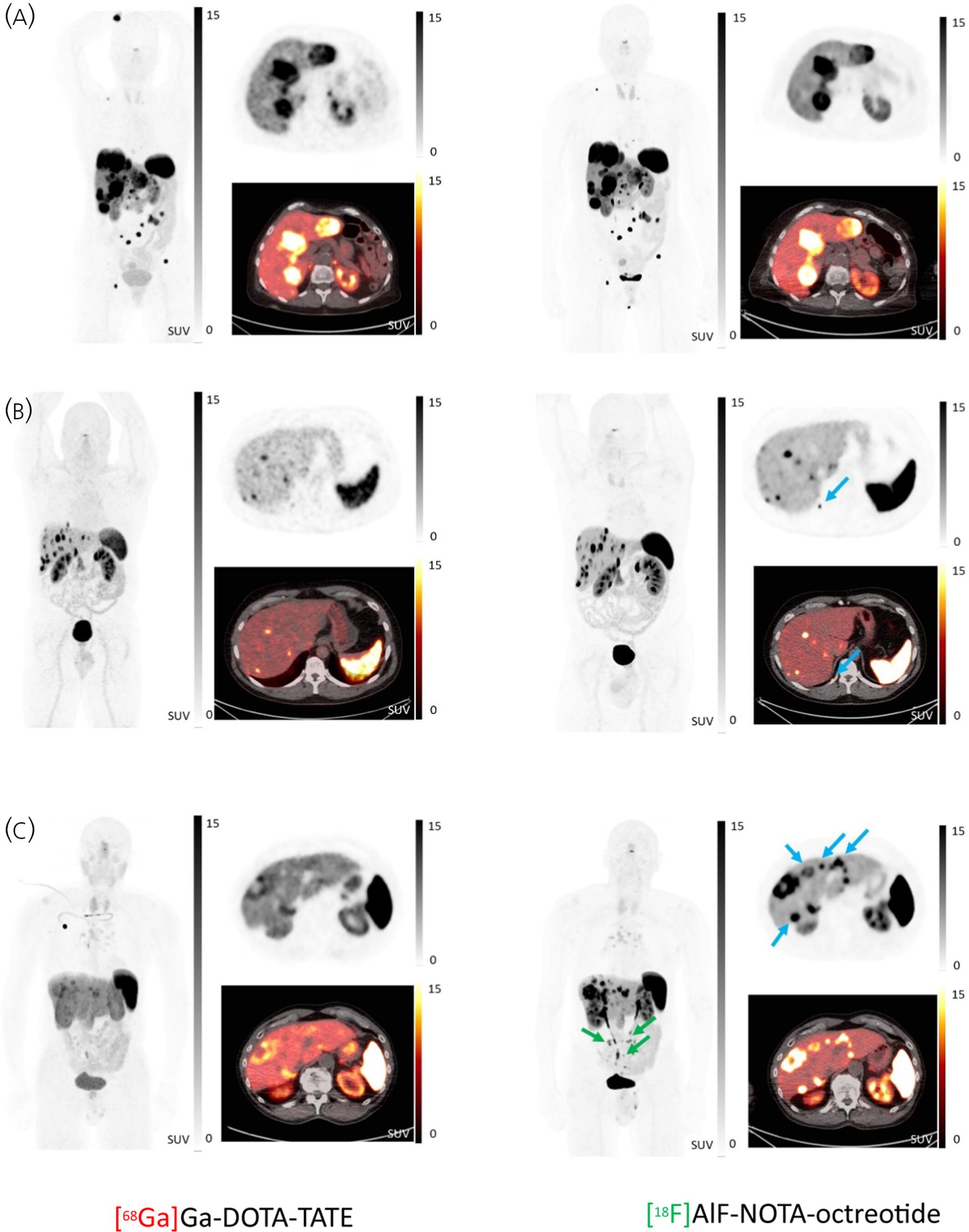 Clinical impact of using [18F]AlF-NOTA-octreotide PET/CT instead of [68Ga]Ga-DOTA-SSA PET/CT: Secondary endpoint analysis of a multicenter, prospective trial