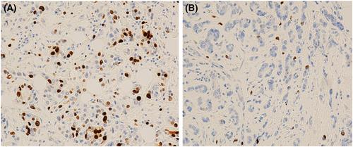 Morphological and molecular changes of oestrogen receptor-positive breast cancer following bridging endocrine therapy: a United Kingdom multicentre study