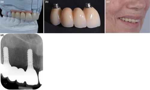 Material and abutment selection for CAD/CAM implant-supported fixed dental prostheses in partially edentulous patients – A narrative review