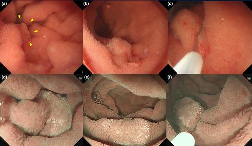 “Cold-water” immersion endoscopic resection: Novel therapeutic technique for nonampullary duodenal lesions